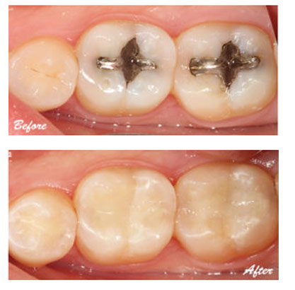Dental Filling