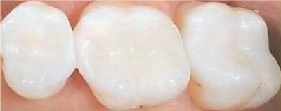 Dental Filling Procedure