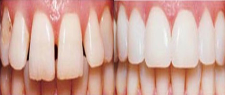 Laminates & Veneers