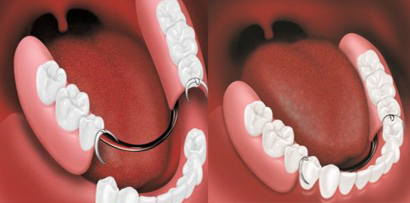 Partial Dentures