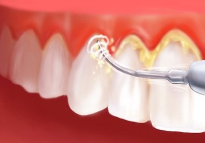 Teeth Cleaning